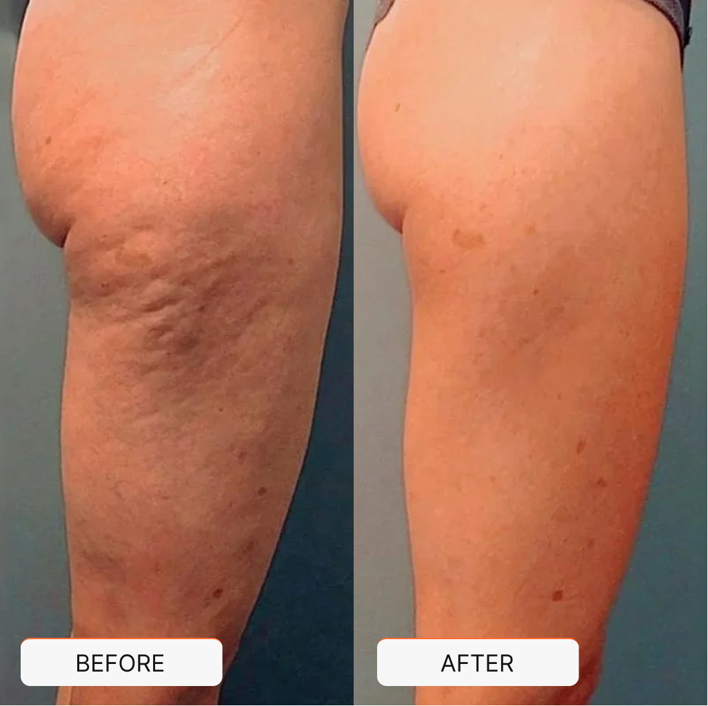 CELLULITE