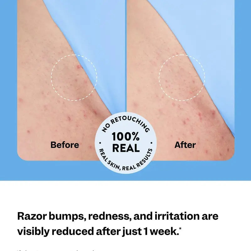 NUVIE Smoothing Solution — Ingrown Hair Treatment Roller