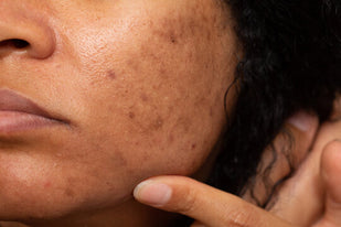 Dark spots & Sun damage