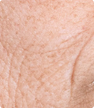 fine lines & wrinkles